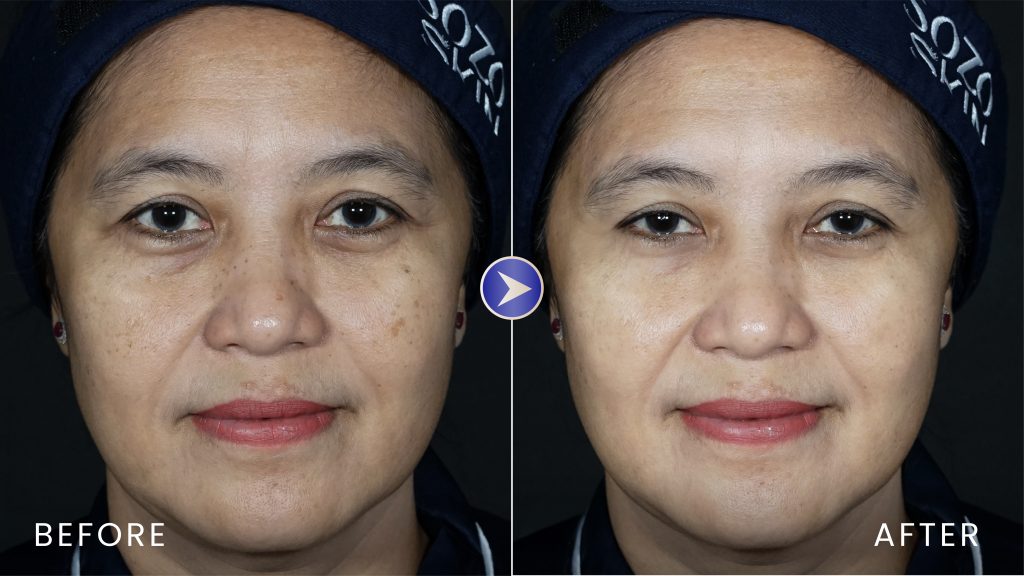 pigmentation before after